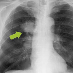 X-ray image of lung with suspected tumor for visualization of the carcinogenicity index | © CRB Analyse Service GmbH